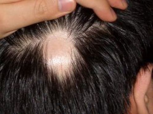 Alopezie Areata