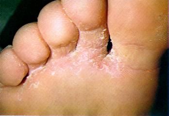 Diese Krankheit wird auch als Fußpilz bezeichnet