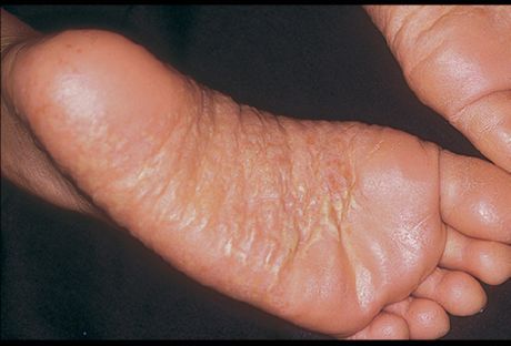 Dermatitis der Beine und ihre Ursachen
