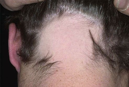 Alopezie Areata