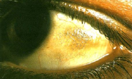 Xerophthalmus.  Die Plaques von Bito sehen erhöht aus, mit der Ablagerung von mehreren Schuppen, Bindehautstellen, die sich in einer Zone befinden, die nicht von Augenlidern bedeckt ist.  Wie in diesem Fall sind pathologische Bereiche oft pigmentiert.