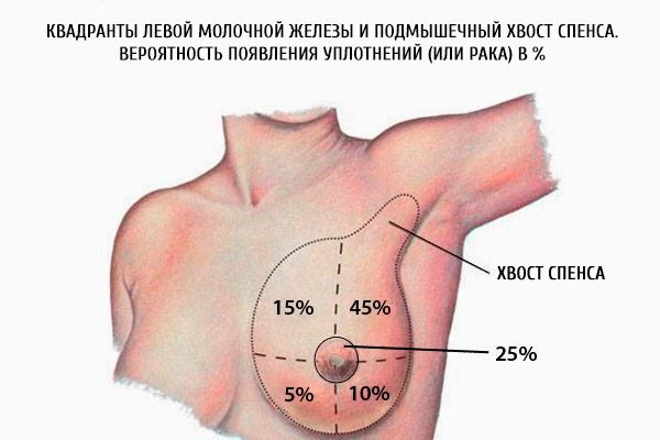 Die Quadranten der linken Brust und die axillare Spence der Spence.  Die Wahrscheinlichkeit von Robben (oder Krebs) in%