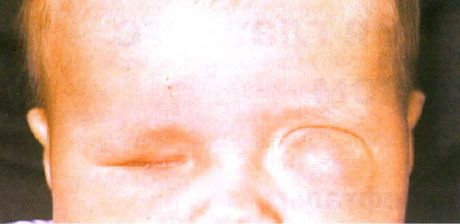 Mikrophthalmus mit gleichzeitiger Zystenbildung (linkes Auge).  Anophthalmus (rechtes Auge).