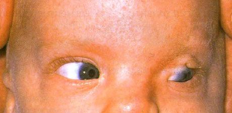 Fraser-Syndrom.  Unvollständiger Kryptophthalmus des linken Auges.
