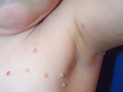 Molluscum contagiosum Foto