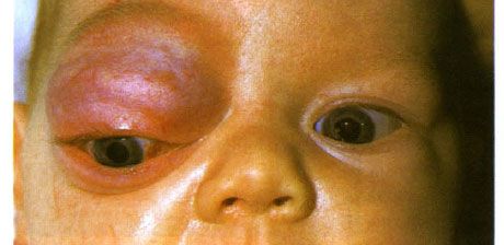 Kapilläres Hämangiom des vorderen Teils der Augenhöhle und des oberen Augenlids.  Neoplasma neigt dazu, Fortschritte zu machen