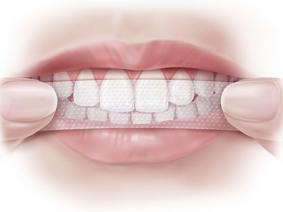Wie verwendet man Bleaching-Streifen für Zähne?