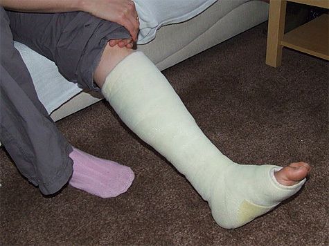 Maßnahmen zu Hause mit Fraktur der Beine