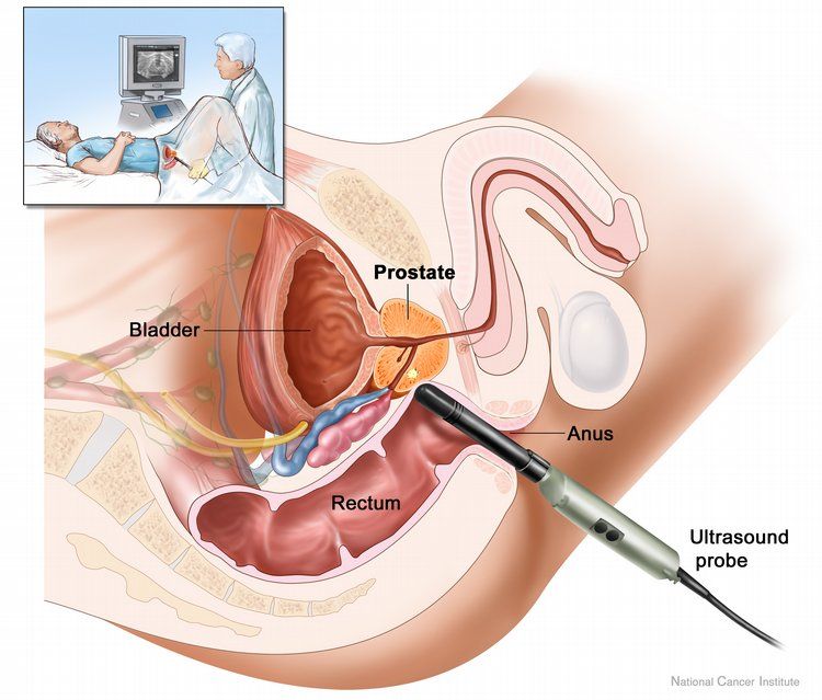 Ein wirksames Medikament gegen Prostatakrebs auf der Basis von Tee und Gold wurde geschaffen