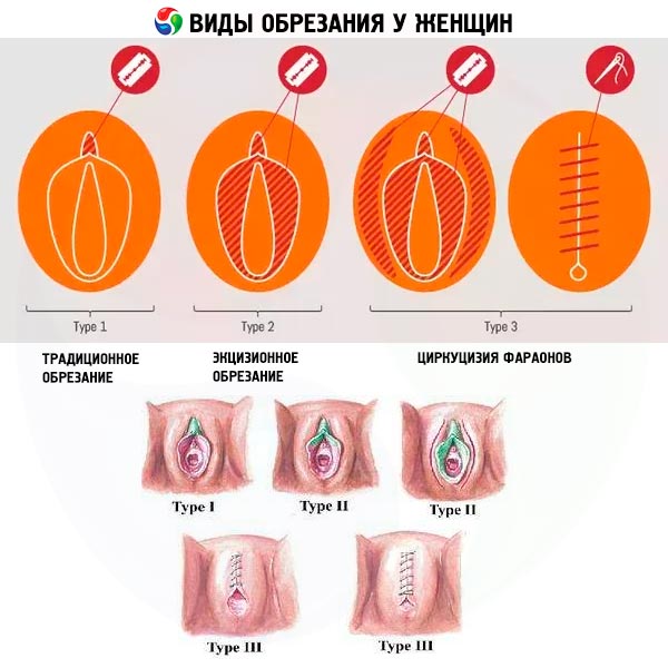 Vagina beschnitten