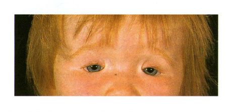 Beidseitiges Kolobom der Augenlider bei einem Kind mit Golden-Syndrom.  Schließung des Augenschlitzes auf der linken Seite