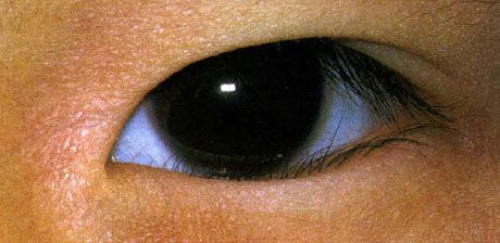 Epipharon.  Falsches Wachstum der Wimpern wird von Geburt an gefeiert.  Manchmal gibt es eine spontane Verbesserung
