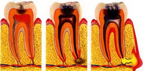 Zahnschmerzen nach dem Füllen 
